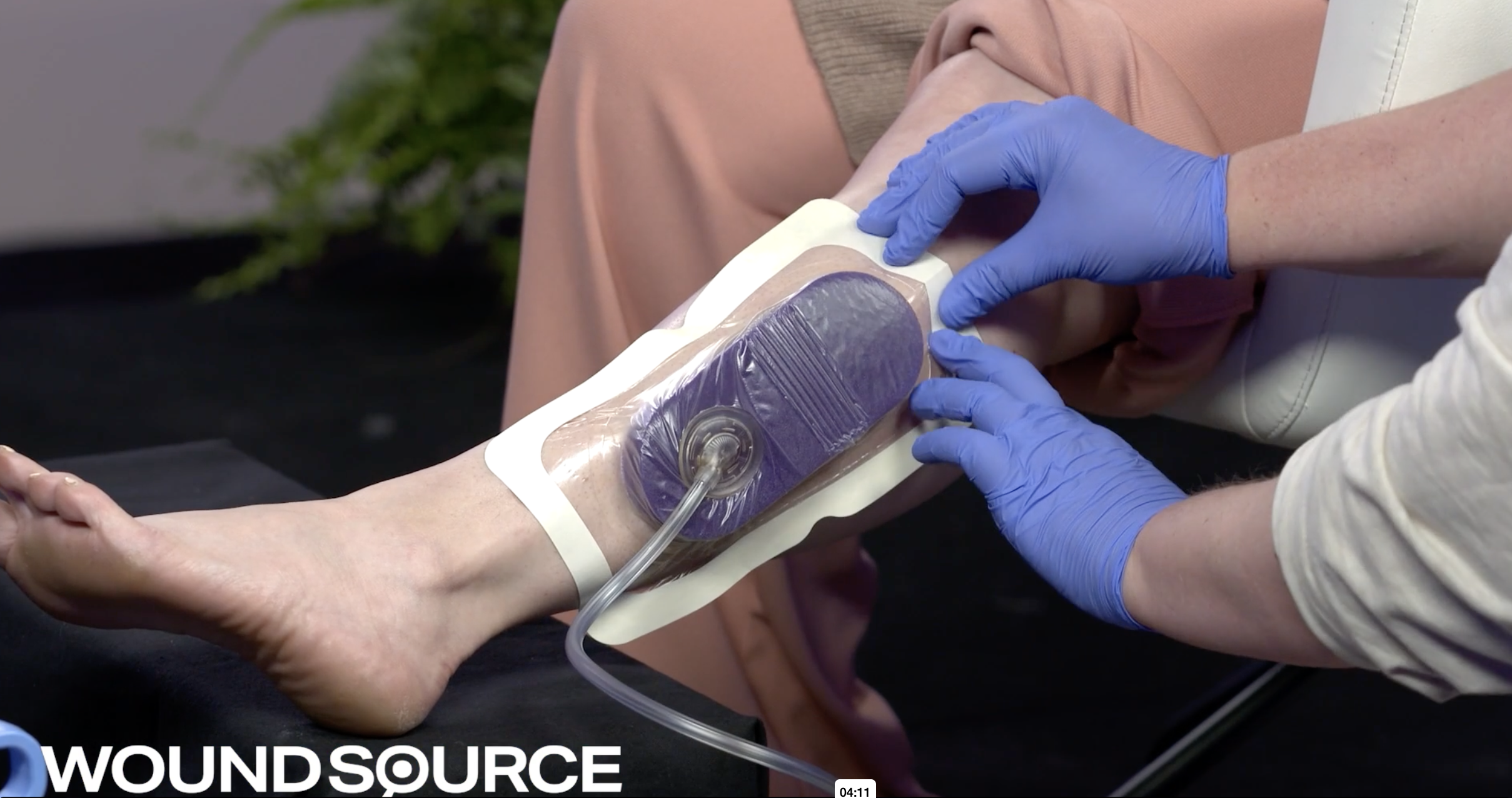 Negative Pressure Wound Therapy with a Unique Dressing Kit
