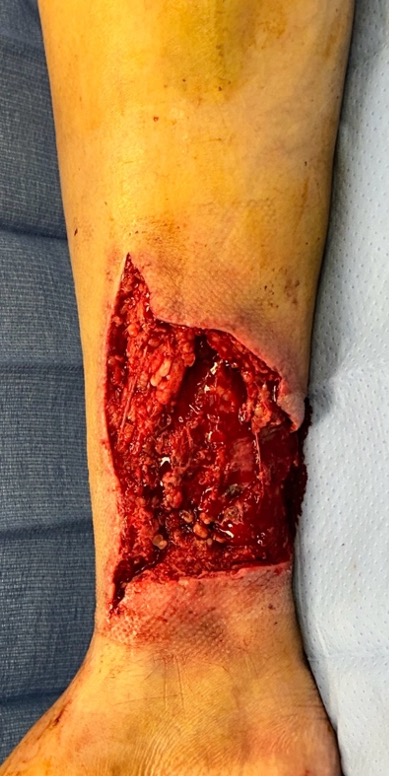 Image post sharp surgical debridement of the necrotic skin flap with a scalpel.