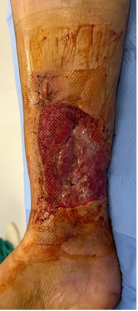 Day 6 postoperatively. 