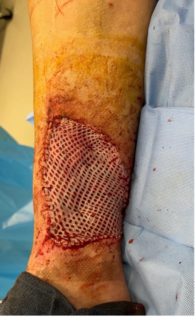 Wound prepared for partial complex layered closure and skin grafting reconstruction.