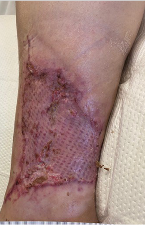 Three weeks postoperatively, demonstrating 95% graft take.