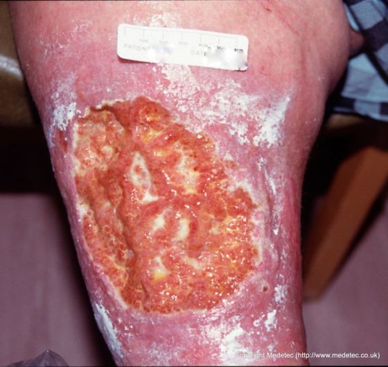 Venous Insufficiency Ulcer, Bariatric Venous Insufficiency Ulcer, Bariatric