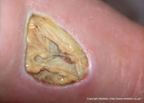 Pressure Ulcer, Leg (Unstageable) Pressure Ulcer, Leg (Unstageable)