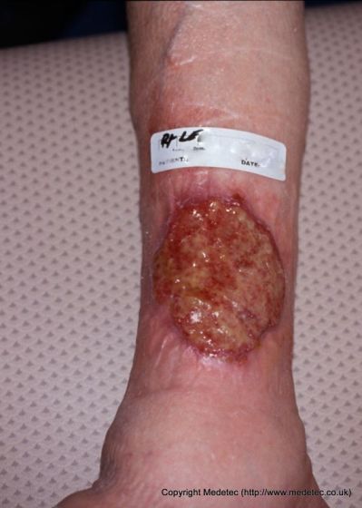 Venous Insufficiency Ulcer Venous Insufficiency Ulcer