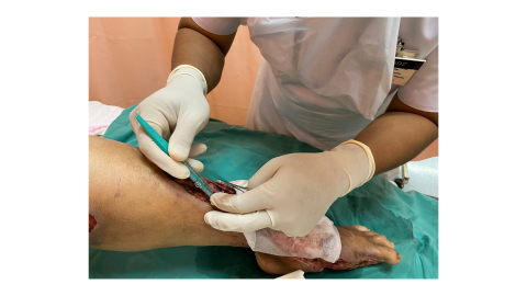Integral Debridement for Complex Wounds: An Expert’s Insights
