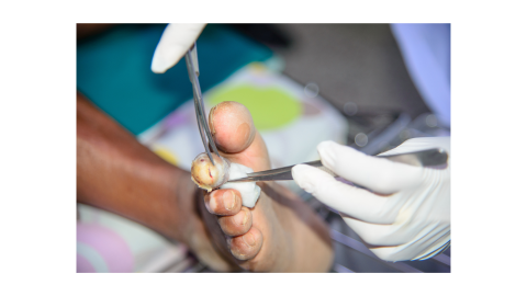 Integral Debridement Throughout the Continuum of Care