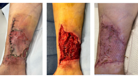 Integral Debridement in the Postoperative Setting: An Expert’s Perspective 